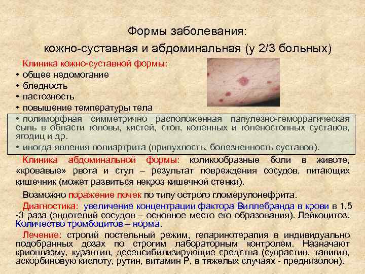 Формы заболевания: кожно-суставная и абдоминальная (у 2/3 больных) Клиника кожно-суставной формы: • общее недомогание
