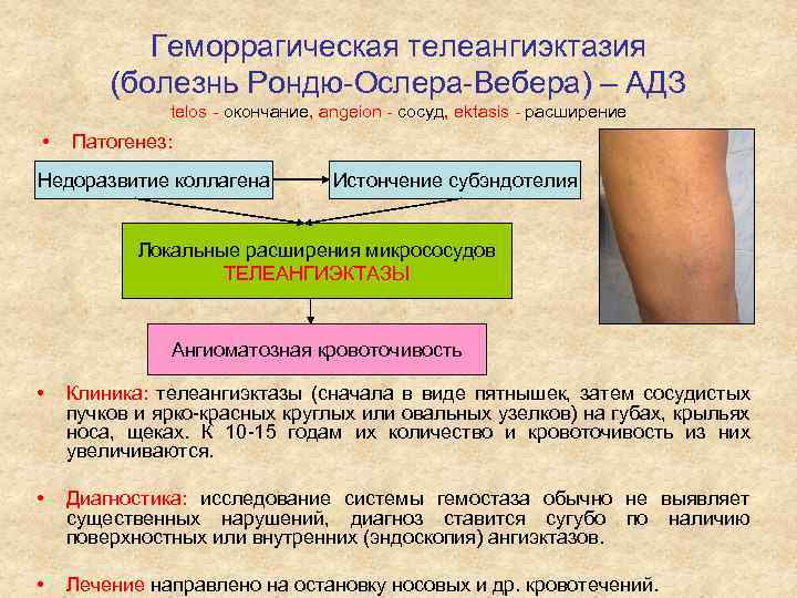 Геморрагическая телеангиэктазия (болезнь Рондю-Ослера-Вебера) – АДЗ telos - окончание, angeion - сосуд, ektasis -
