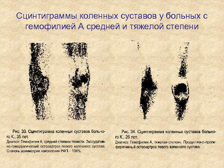 Сцинтиграммы коленных суставов у больных с гемофилией А средней и тяжелой степени 