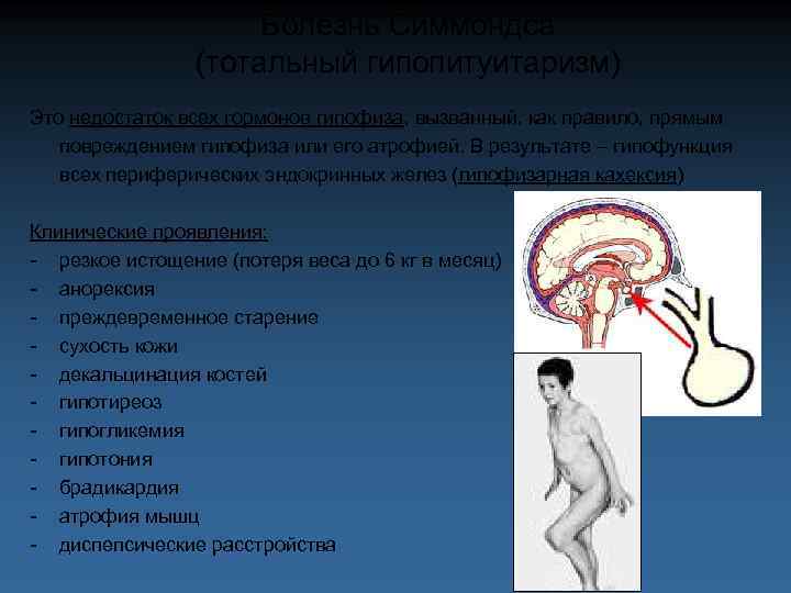 Болезнь Симмондса (тотальный гипопитуитаризм) Это недостаток всех гормонов гипофиза, вызванный, как правило, прямым повреждением