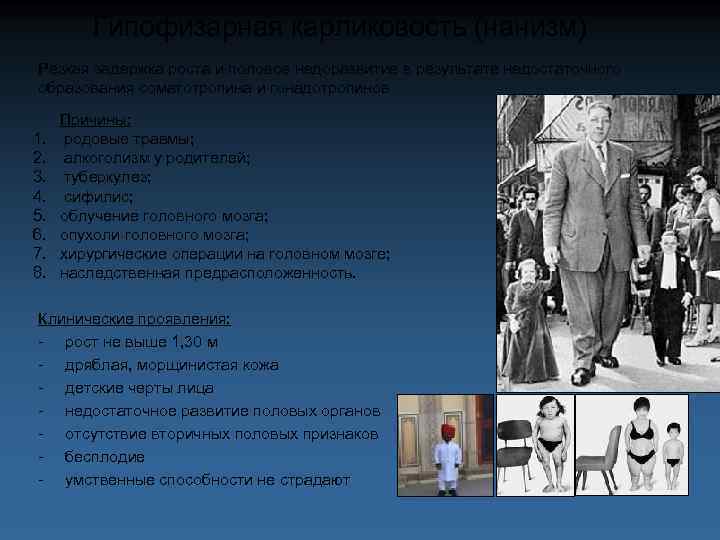 Гипофизарная карликовость (нанизм) Резкая задержка роста и половое недоразвитие в результате недостаточного образования соматотропина