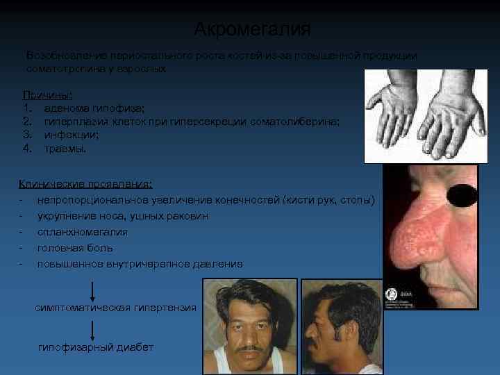 Акромегалия Возобновление периостального роста костей из-за повышенной продукции соматотропина у взрослых Причины: 1. аденома