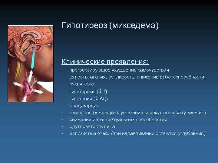 Гипотиреоз (микседема) Клинические проявления: - прогрессирующее ухудшение самочувствия вялость, апатия, сонливость, снижение работоспособности сухая