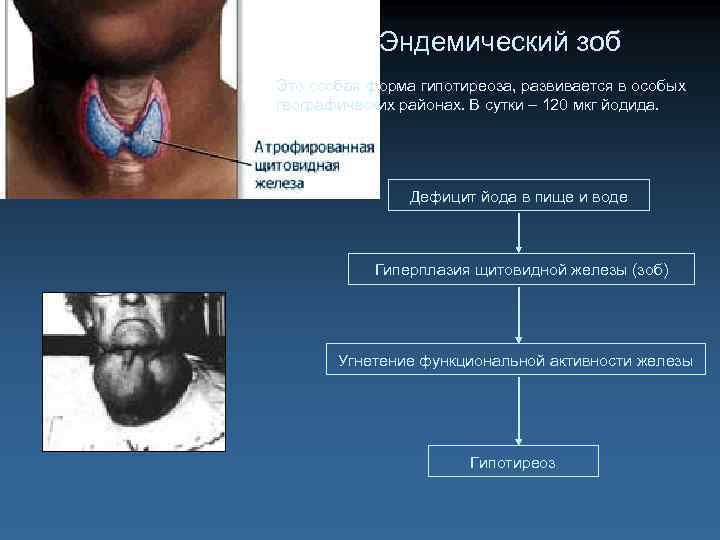 Эндемический зоб Это особая форма гипотиреоза, развивается в особых географических районах. В сутки –