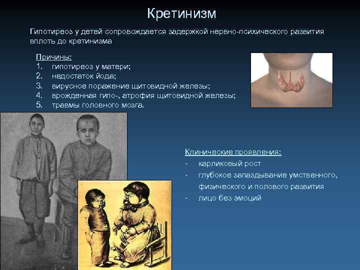 Кретинизм Гипотиреоз у детей сопровождается задержкой нервно-психического развития вплоть до кретинизма Причины: 1. гипотиреоз