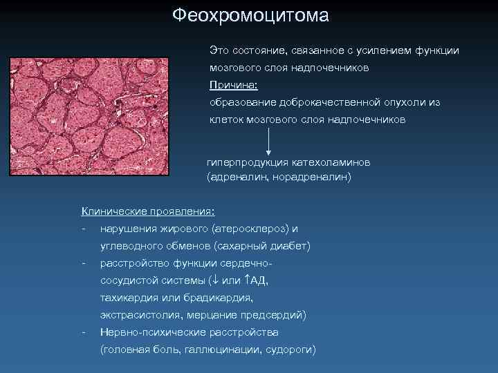 Феохромоцитома Это состояние, связанное с усилением функции мозгового слоя надпочечников Причина: образование доброкачественной опухоли