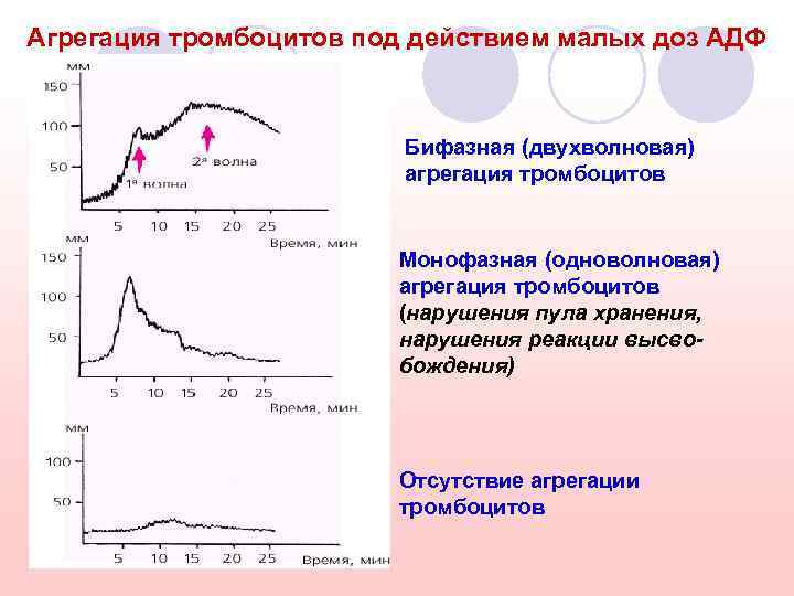 Агрегация тромбоцитов под действием малых доз АДФ Бифазная (двухволновая) агрегация тромбоцитов Монофазная (одноволновая) агрегация