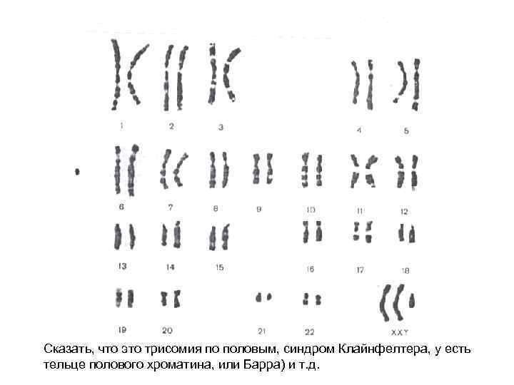 Сказать, что это трисомия по половым, синдром Клайнфелтера, у есть тельце полового хроматина, или