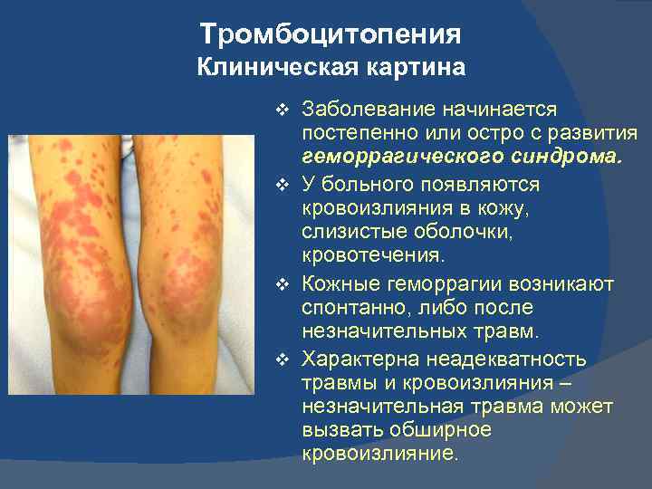 Тромбоцитопения Клиническая картина v v Заболевание начинается постепенно или остро с развития геморрагического синдрома.