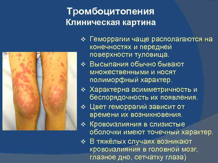 Тромбоцитопения Клиническая картина v v v Геморрагии чаще располагаются на конечностях и передней поверхности