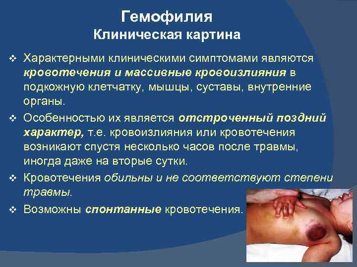 Гемофилия Клиническая картина v v Характерными клиническими симптомами являются кровотечения и массивные кровоизлияния в