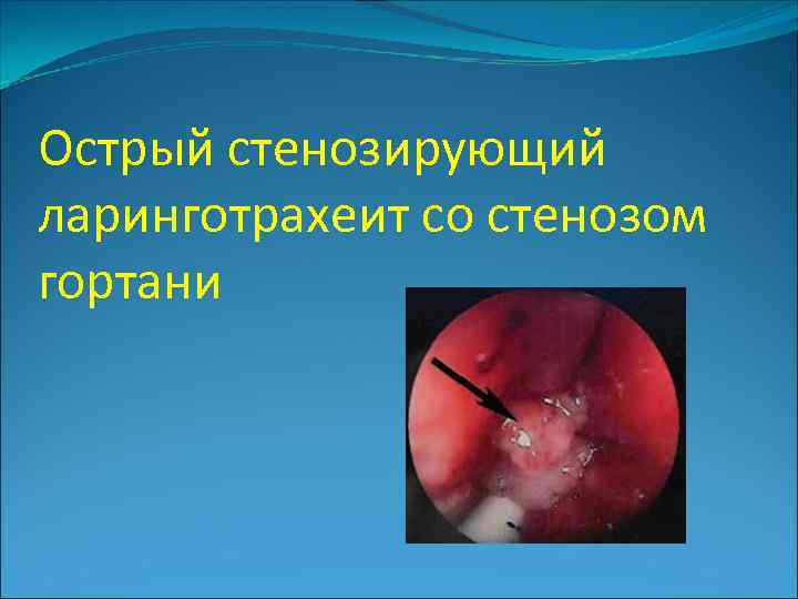Острый стенозирующий ларинготрахеит со стенозом гортани 