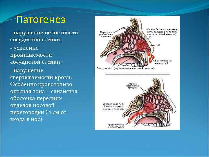 Патогенез - нарушение целостности сосудистой стенки; - усиление проницаемости сосудистой стенки; - нарушение свертываемости