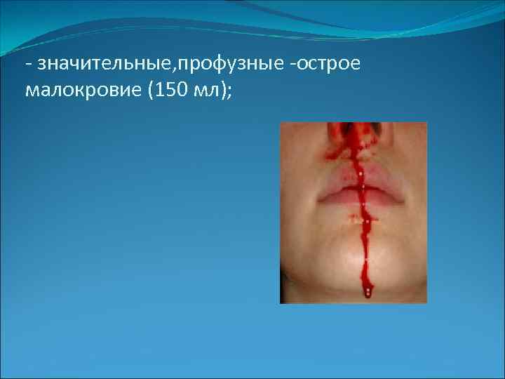 - значительные, профузные -острое малокровие (150 мл); 