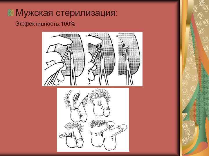Мужская стерилизация: Эффективность: 100% 