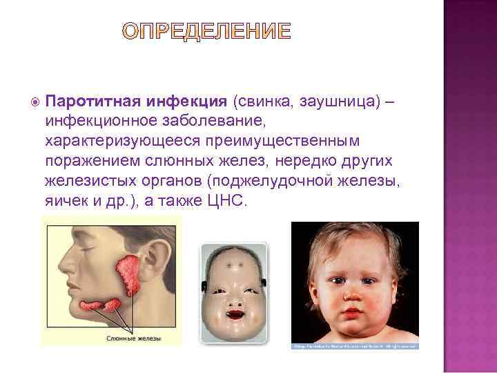  Паротитная инфекция (свинка, заушница) – инфекционное заболевание, характеризующееся преимущественным поражением слюнных желез, нередко