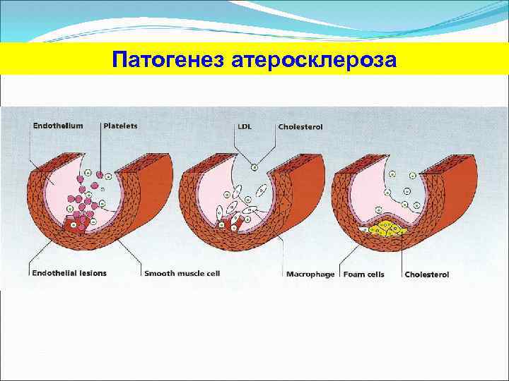 Теории патогенеза атеросклероза. Аутоиммунная теория атеросклероза патогенез. Патогенез атеросклероза патофизиология схема. Схема формирования атеросклеротической бляшки.