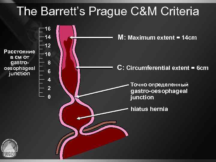 The Barrett’s Prague C&M Criteria 16 14 Расстояние в cм от gastrooesophageal junction M: