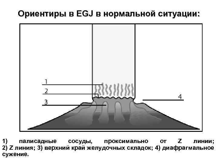 Ориентиры в EGJ в нормальной ситуации: 1) палисадные сосуды, проксимально от Z линии; 2)