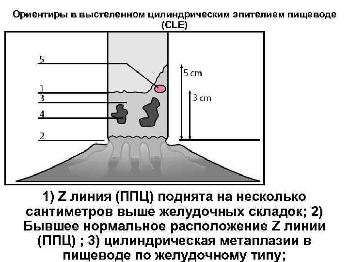 Ориентиры в выстеленном цилиндрическим эпителием пищеводе (CLE) 1) Z линия (ППЦ) поднята на несколько