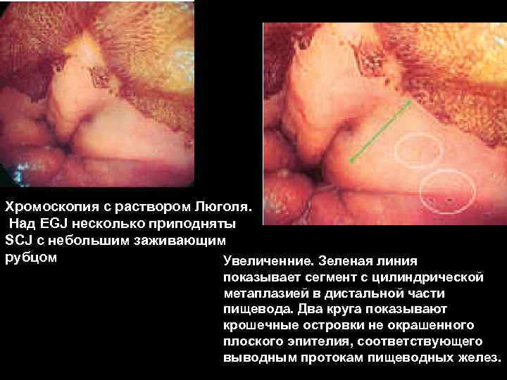 Хромоскопия с раствором Люголя. Над EGJ несколько приподняты SCJ с небольшим заживающим рубцом Увеличенние.