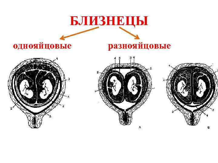 БЛИЗНЕЦЫ однояйцовые разнояйцовые 