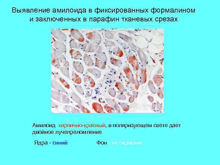 Выявление амилоида в фиксированных формалином и заключенных в парафин тканевых срезах Амилоид кирпично-красный, в