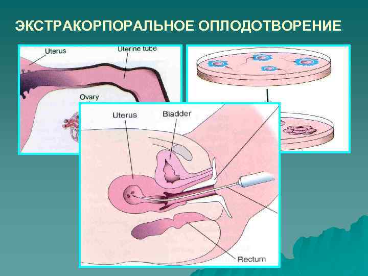 ЭКСТРАКОРПОРАЛЬНОЕ ОПЛОДОТВОРЕНИЕ 