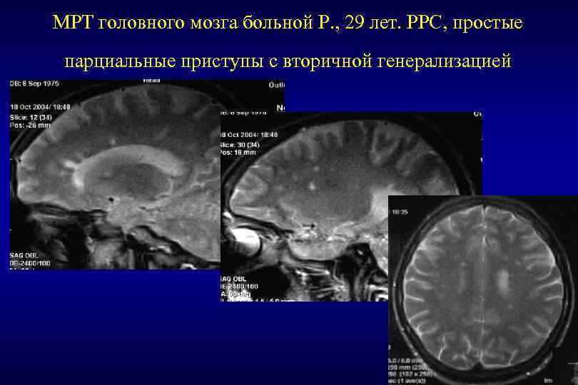 МРТ головного мозга больной Р. , 29 лет. РРС, простые б парциальные приступы с