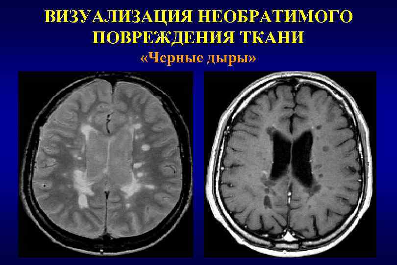 ВИЗУАЛИЗАЦИЯ НЕОБРАТИМОГО ПОВРЕЖДЕНИЯ ТКАНИ «Черные дыры» 