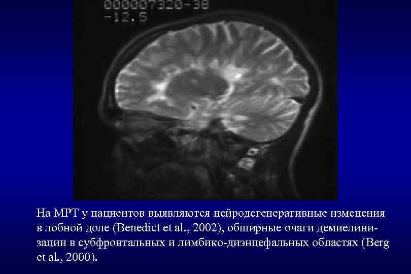 На МРТ у пациентов выявляются нейродегенеративные изменения в лобной доле (Benedict et al. ,
