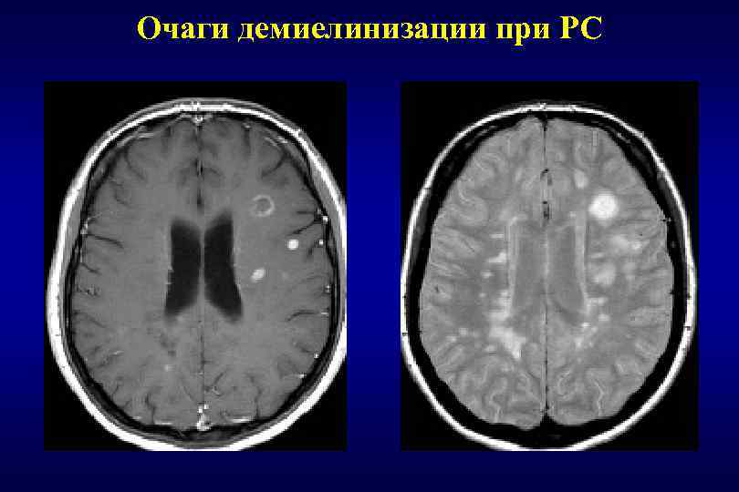 Очаги демиелинизации при РС 