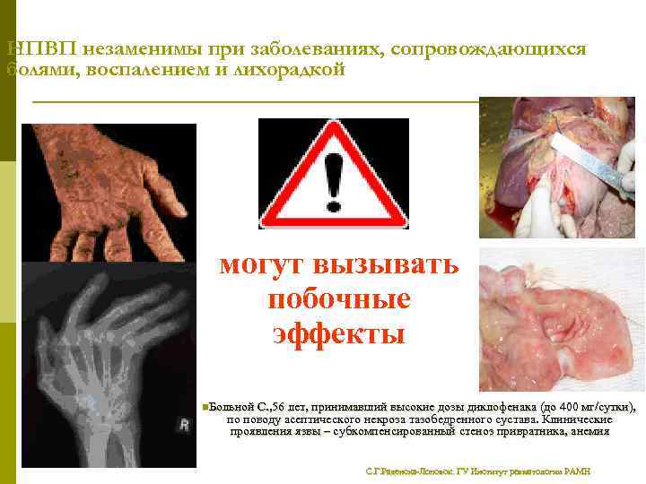 НПВП незаменимы при заболеваниях, сопровождающихся болями, воспалением и лихорадкой могут вызывать побочные эффекты n.