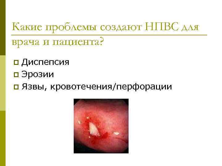 Какие проблемы создают НПВС для врача и пациента? Диспепсия p Эрозии p Язвы, кровотечения/перфорации