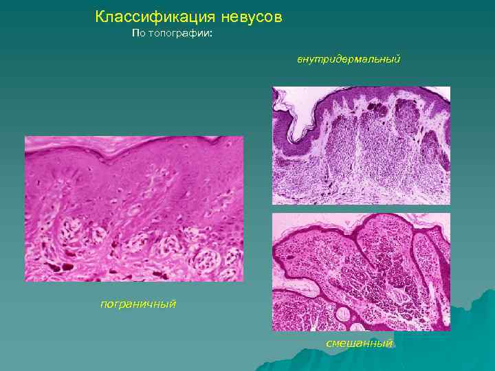 Классификация невусов По топографии: внутридермальный пограничный смешанный 