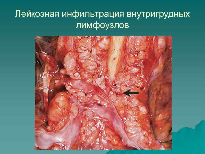 Лейкозная инфильтрация внутригрудных лимфоузлов 