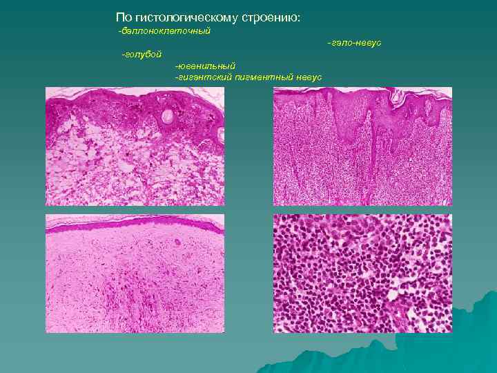 По гистологическому строению: -баллоноклеточный - гало-невус -голубой -ювенильный -гигантский пигментный невус 