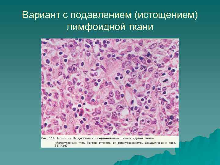 Вариант с подавлением (истощением) лимфоидной ткани 