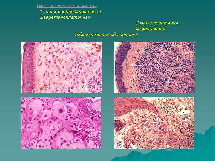Гистологические варианты: 1. эпителиоидноклеточная 2. веретеноклеточная 3. мелкоклеточная 4. смешанная 5. беспигментный вариант 