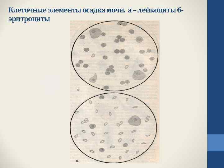 Лейкоциты в моче у собаки. Эритроциты в моче под микроскопом. Клеточные элементы мочи.