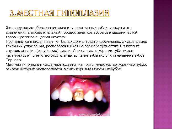  3. МЕСТНАЯ ГИПОПЛАЗИЯ Это нарушение образования эмали на постоянных зубах в результате вовлечения