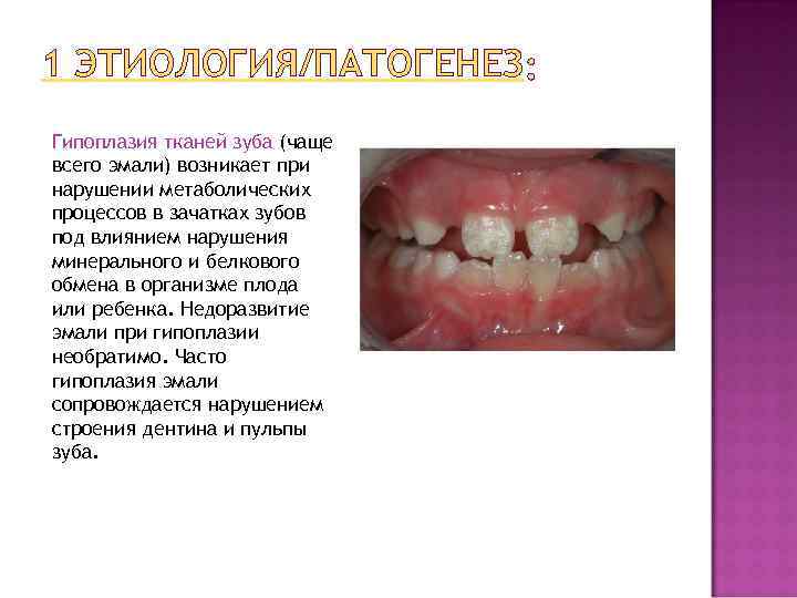 1 ЭТИОЛОГИЯ/ПАТОГЕНЕЗ Гипоплазия тканей зуба (чаще всего эмали) возникает при нарушении метаболических процессов в