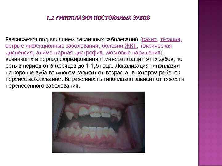  1. 2 ГИПОПЛАЗИЯ ПОСТОЯННЫХ ЗУБОВ Развивается под влиянием различных заболеваний (рахит, тетания, острые