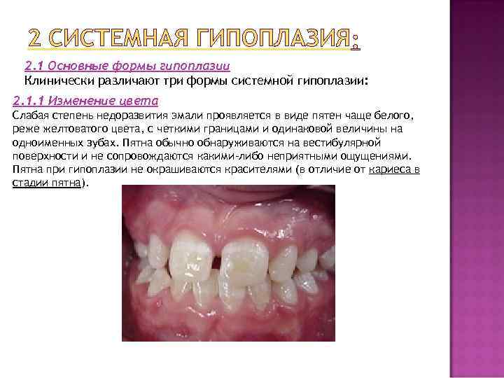  2 СИСТЕМНАЯ ГИПОПЛАЗИЯ 2. 1 Основные формы гипоплазии Клинически различают три формы системной