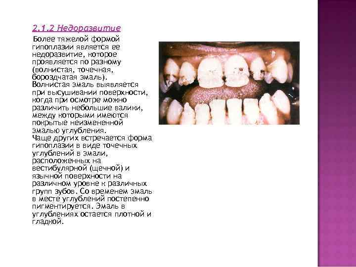 2. 1. 2 Недоразвитие Более тяжелой формой гипоплазии является ее недоразвитие, которое проявляется по