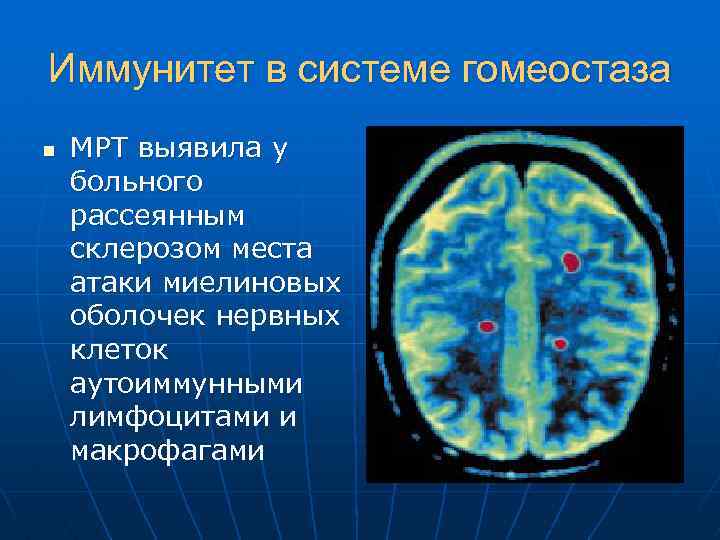 Иммунитет в системе гомеостаза n МРТ выявила у больного рассеянным склерозом места атаки миелиновых