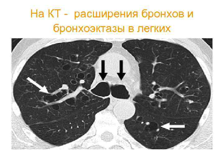 Бронхообструктивный синдром у детей презентация