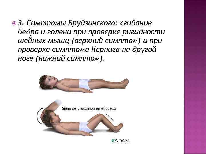  3. Симптомы Брудзинского: сгибание бедра и голени проверке ригидности шейных мышц (верхний симптом)