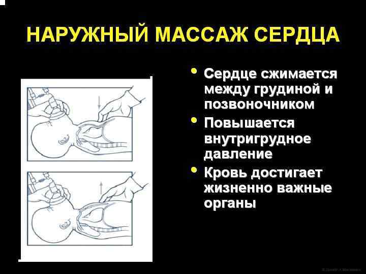 D Блок D (Лекарственные средства). Вы назначаете адреналин, продолжая искусственную вентиляцию под положительным давлением