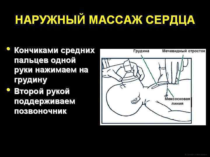 Какое оборудование должно быть под рукой? Оборудование для интубации l Ларингоскоп с прямыми клинками,